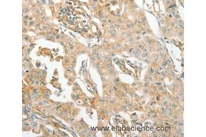 Immunohistochemistry of Human lung cancer using ACE Polyclonal Antibody at dilution of 1:70 (Angiotensin I Converting Enzyme 1 Antikörper)
