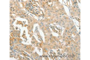 Immunohistochemistry of Human lung cancer using ACE Polyclonal Antibody at dilution of 1:70