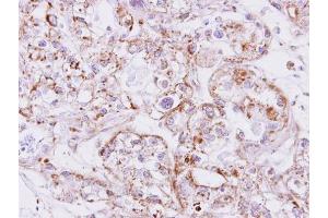 IHC-P Image Immunohistochemical analysis of paraffin-embedded CLEAR CELL OVCA xenograft, using Inhibin beta A, antibody at 1:500 dilution. (INHBA Antikörper  (C-Term))