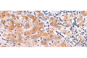 Immunohistochemistry of paraffin-embedded Human liver cancer tissue using ITGA11 Polyclonal Antibody at dilution of 1:75(x200) (ITGA11 Antikörper)