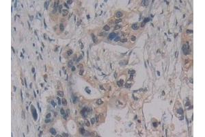 Detection of MPG1 in Human Pancreatic cancer Tissue using Polyclonal Antibody to Macrophage Expressed Gene 1 Protein (MPG1) (MPEG1 Antikörper  (AA 313-580))