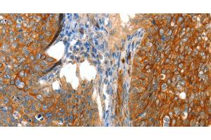 Immunohistochemistry of paraffin-embedded Human cervical cancer tissue using VWA5A Polyclonal Antibody at dilution 1:80 (VWA5A Antikörper)