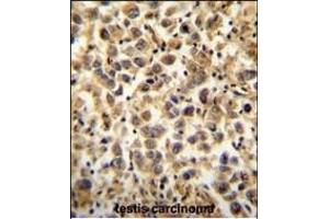 CCDC19 Antibody (N-term) (ABIN654396 and ABIN2844138) immunohistochemistry analysis in formalin fixed and paraffin embedded human testis carcinoma followed by peroxidase conjugation of the secondary antibody and DAB staining. (CCDC19 Antikörper  (N-Term))