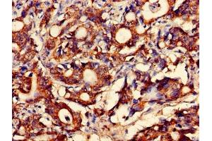Immunohistochemistry of paraffin-embedded human gastric cancer using ABIN7160449 at dilution of 1:100 (FAM168B Antikörper  (AA 43-100))