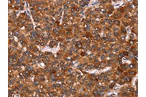 The image on the left is immunohistochemistry of paraffin-embedded Human liver cancer tissue using ABIN7190739(GAGE12I Antibody) at dilution 1/20, on the right is treated with synthetic peptide. (G Antigen 12I Antikörper)