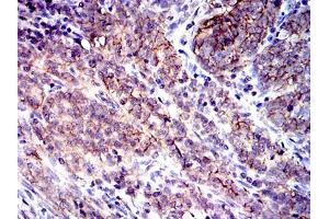 Immunohistochemical analysis of paraffin-embedded cervical cancer tissues using CD9 mouse mAb with DAB staining.