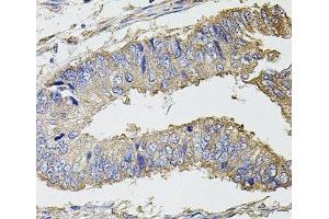 Immunohistochemistry of paraffin-embedded Human colon carcinoma using UBE2S Polyclonal Antibody at dilution of 1:100 (40x lens). (UBE2S Antikörper)