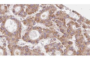 ABIN6273962 at 1/100 staining Human liver cancer tissue by IHC-P. (OR6C75 Antikörper)