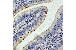 Immunohistochemical analysis of CCT3 staining in human colon cancer formalin fixed paraffin embedded tissue section. (CCT3 Antikörper)
