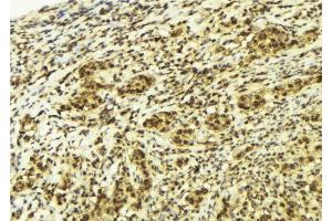 ABIN6277988 at 1/100 staining Human breast cancer tissue by IHC-P. (CTNNBL1 Antikörper  (N-Term))