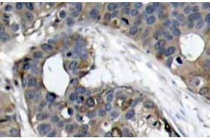 Immunohistochemistry (IHC) analyzes of HSP27 antibody in paraffin-embedded human breast carcinoma tissue. (HSP27 Antikörper)