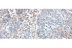 Immunohistochemistry of paraffin-embedded Human lung cancer tissue using WFDC5 Polyclonal Antibody at dilution of 1:60(x200) (WFDC5 Antikörper)