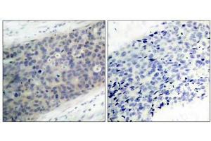 Immunohistochemical analysis of paraffin- embedded human breast carcinoma tissue using LIMK2 (phospho-Thr505) antibody (E011127). (LIMK2 Antikörper  (pThr505))
