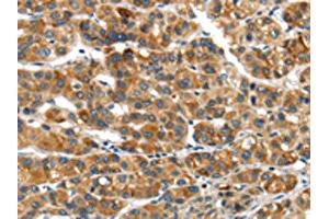 The image on the left is immunohistochemistry of paraffin-embedded Human liver cancer tissue using ABIN7192974(UBAP2 Antibody) at dilution 1/20, on the right is treated with synthetic peptide. (UBAP2 Antikörper)