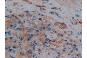 Detection of AQP1 in Human Prostate cancer Tissue using Polyclonal Antibody to Aquaporin 1 (AQP1) (Aquaporin 1 Antikörper  (AA 201-269))