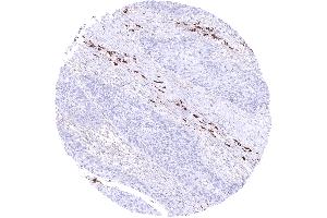 Squamous cell carcinoma containing many IgA positive plasma cells in its stroma (Rekombinanter Kaninchen anti-Human IgA Antikörper)