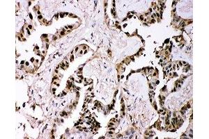 IHC-P: GSTP1 antibody testing of human lung cancer tissue (GSTP1 Antikörper  (AA 2-210))