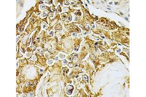 Immunohistochemistry of paraffin-embedded Human esophageal cancer using ADRBK1 Polyclonal Antibody at dilution of 1:200 (40x lens). (GRK2 Antikörper)