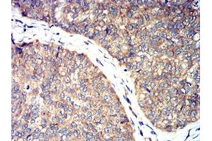 Immunohistochemical analysis of paraffin-embedded ROP1 tissues using bladder cancer mouse mAb with DAB staining.