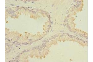 Immunohistochemistry of paraffin-embedded human prostate cancer using ABIN7159008 at dilution of 1:100 (MARCKSL1 Antikörper  (AA 1-195))