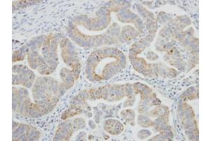 IHC-P Image Immunohistochemical analysis of paraffin-embedded human gastric cancer, using SRPR, antibody at 1:100 dilution.