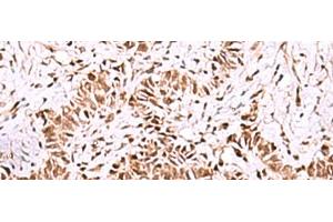 Immunohistochemistry of paraffin-embedded Human ovarian cancer tissue using ISY1-RAB43 Polyclonal Antibody at dilution of 1:55(x200) (ISY1-RAB43 Readthrough (ISY1-RAB43) Antikörper)