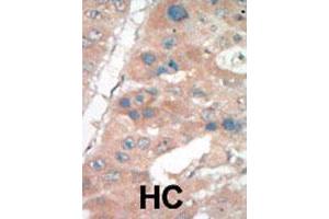 Formalin-fixed and paraffin-embedded human hepatocellular carcinoma tissue reacted with CDKN1A polyclonal antibody  , which was peroxidase-conjugated to the secondary antibody, followed by DAB staining. (p21 Antikörper  (C-Term))