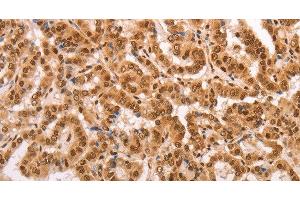 Immunohistochemistry of paraffin-embedded Human thyroid cancer tissue using HEXIM1 Polyclonal Antibody at dilution 1:65 (HEXIM1 Antikörper)