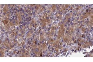 ABIN6277011 at 1/100 staining Human liver cancer tissue by IHC-P. (BMPR1B Antikörper  (N-Term))