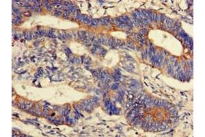 Immunohistochemistry of paraffin-embedded human colon cancer using ABIN7165956 at dilution of 1:100