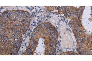 Immunohistochemistry of paraffin-embedded Human colon cancer tissue using NDUFA1 Polyclonal Antibody at dilution 1:30 (NDUFA1 Antikörper)