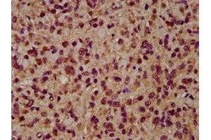 IHC image of ABIN7143995 diluted at 1:200 and staining in paraffin-embedded human glioma performed on a Leica BondTM system. (AIMP1 Antikörper  (AA 25-180))