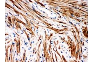 IHC-P: IkB beta antibody testing of human intestinal cancer tissue (NFKBIB Antikörper  (AA 56-237))