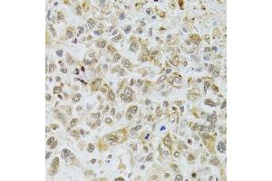 Immunohistochemistry of paraffin-embedded human lung cancer using DMAP1 antibody. (DMAP1 Antikörper  (AA 1-305))