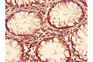 Immunohistochemistry of paraffin-embedded human colon cancer using ABIN7151381 at dilution of 1:100 (ENTPD8 Antikörper  (AA 30-434))