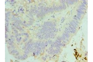 Immunohistochemistry of paraffin-embedded human colon cancer using ABIN7160089 at dilution of 1:100
