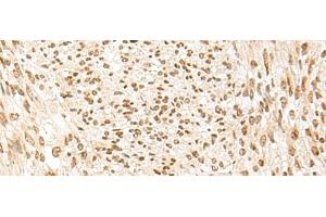 Immunohistochemistry of paraffin-embedded Human liver cancer tissue using POM121 Polyclonal Antibody at dilution of 1:75(x200) (POM121 Antikörper)