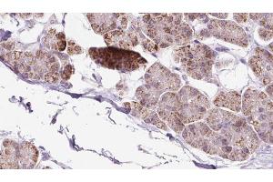 ABIN6273241 at 1/100 staining Human pancreas cancer tissue by IHC-P. (EXOC5 Antikörper  (Internal Region))