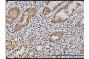 Immunohistochemistry (IHC) image for anti-Cadherin 1, Type 1, E-Cadherin (Epithelial) (CDH1) (AA 381-481) antibody (ABIN614587) (E-cadherin Antikörper  (AA 381-481))