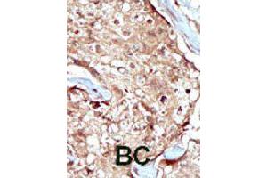 Formalin-fixed and paraffin-embedded human cancer tissue reacted with PAPSS2 polyclonal antibody  , which was peroxidase-conjugated to the secondary antibody, followed by AEC staining. (PAPSS2 Antikörper  (C-Term))