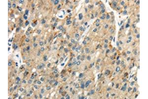 The image on the left is immunohistochemistry of paraffin-embedded Human liver cancer tissue using ABIN7190275(CLDN19 Antibody) at dilution 1/35, on the right is treated with synthetic peptide. (Claudin 19 Antikörper)