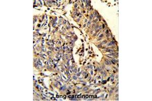 Formalin-fixed and paraffin-embedded human Lung carcinoma reacted with C21orf29 Antibody (Center), which was peroxidase-conjugated to the secondary antibody, followed by DAB staining. (TSPEAR Antikörper  (Middle Region))