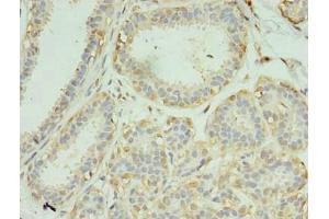 Immunohistochemistry of paraffin-embedded human breast cancer using ABIN7168731 at dilution of 1:100
