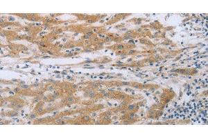 Immunohistochemistry of paraffin-embedded Human liver cancer using TNK2 Polyclonal Antibody at dilution of 1:70 (TNK2 Antikörper)