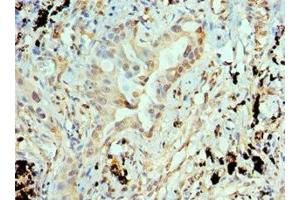 Immunohistochemistry of paraffin-embedded human lung cancer using ABIN7144325 at dilution of 1:100 (ANTXR1 Antikörper  (AA 315-564))