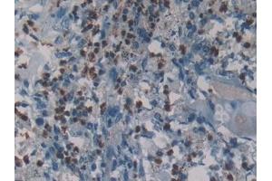 Detection of NE in Human Lung cancer Tissue using Polyclonal Antibody to Neutrophil Elastase (NE) (ELANE Antikörper  (AA 30-247))