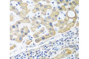 Immunohistochemistry of paraffin-embedded Human liver cancer using GLUD1 Polyclonal Antibody at dilution of 1:100 (40x lens).