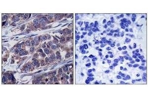 Immunohistochemical analysis of paraffin-embedded human breast carcinoma tissue using p62Dok(Phospho-Tyr362) Antibody(left) or the same antibody preincubated with blocking peptide(right). (DOK1 Antikörper  (pTyr362))