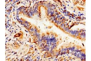 Immunohistochemistry of paraffin-embedded human lung cancer using ABIN7144912 at dilution of 1:100 (ABCD1 Antikörper  (AA 632-745))