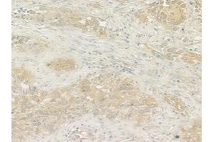 ABIN6262569 and ABIN6276630 at 1/100 staining human lung squamous cell carcinoma by IHC-P.